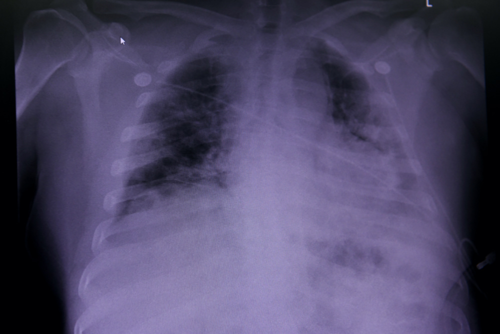 Coronavirus X ray showing lung damage