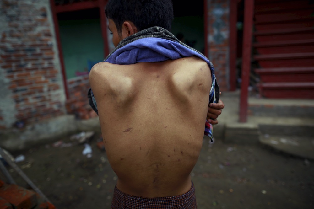 Rohingya human trafficking survivor