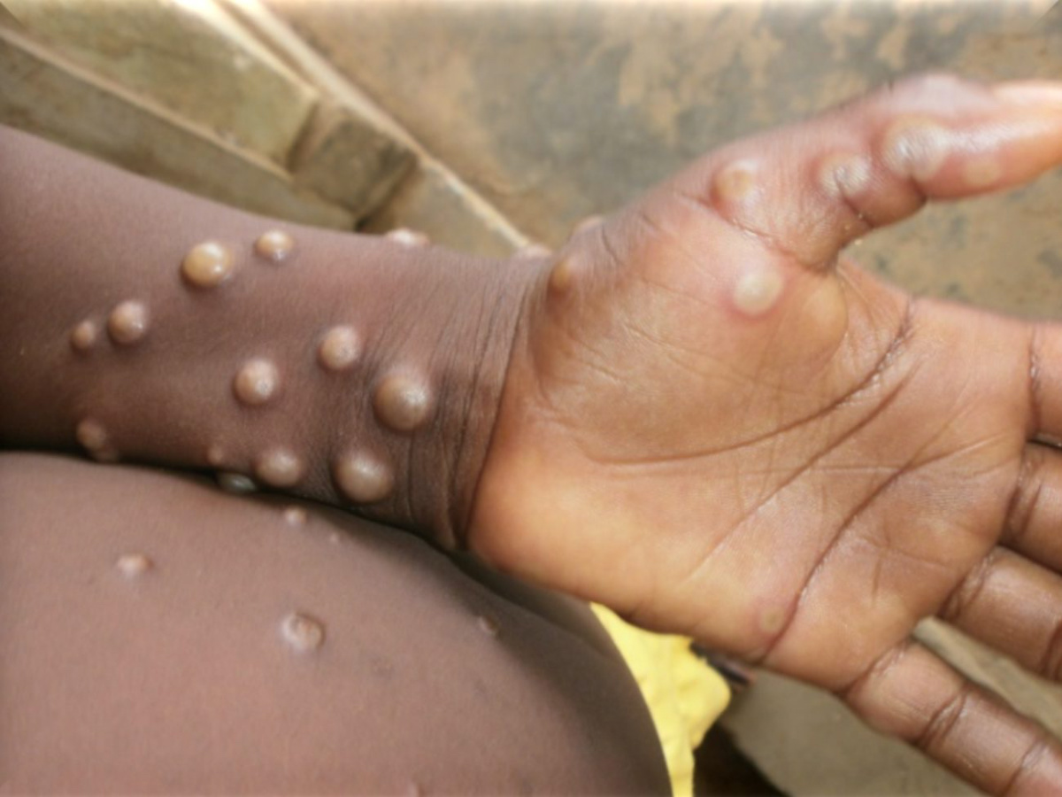 Monkeypox Infection