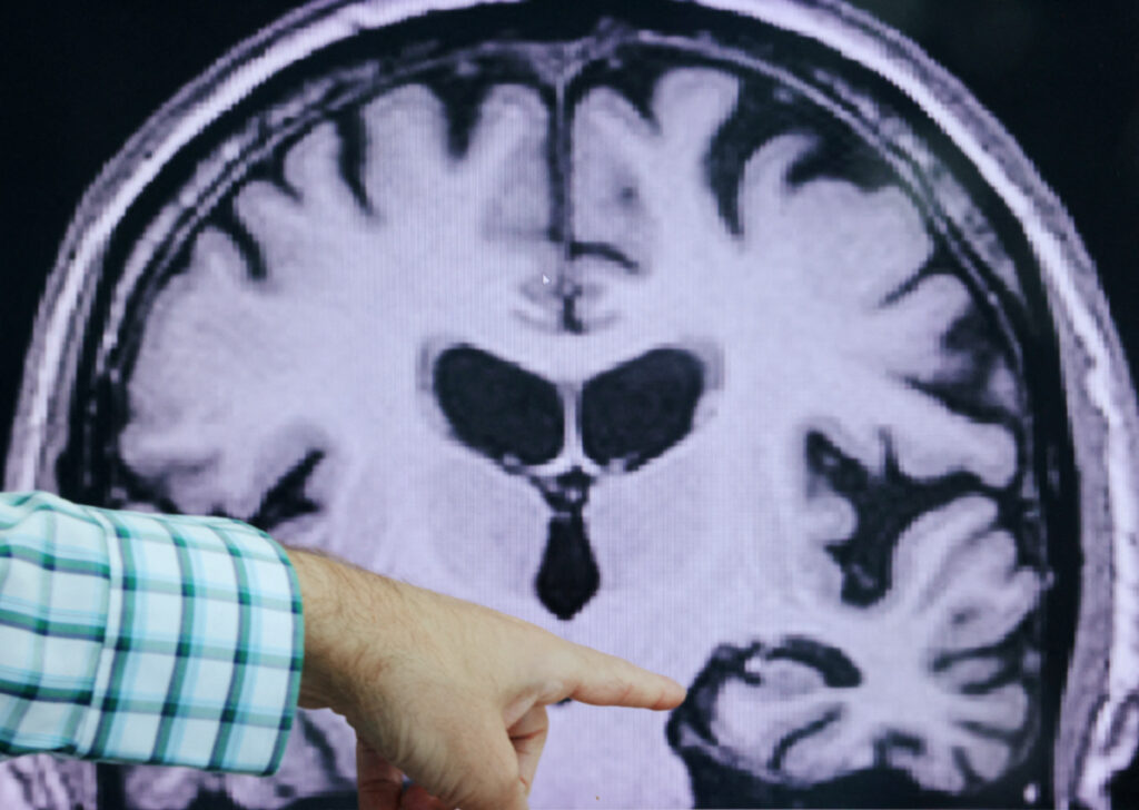 Dr Seth Gale points out evidence of Alzheimer’s disease on an MRI at the Center for Alzheimer Research and Treatment at Brigham And Women’s Hospital in Boston, Massachusetts, US, on 30th March, 2023.