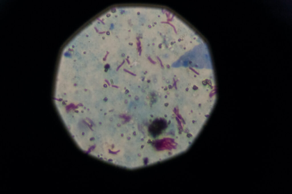 A sample that tested positive for tuberculosis is seen from a microscope in Buenos Aires, Argentina, on 29th March, 2019